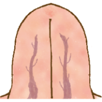 2本の静脈が青黒く腫れている